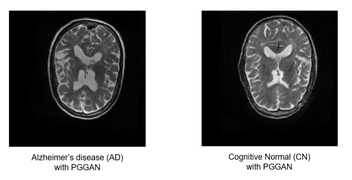 Alzheimer's Disease Classification
