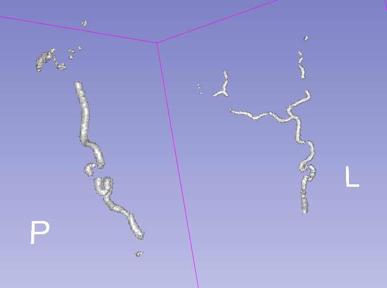 3D Artery Segmentation