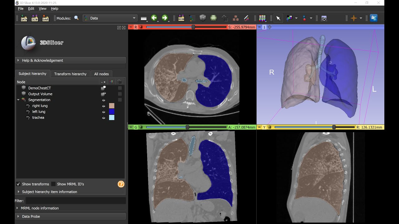 Lung Segmentation